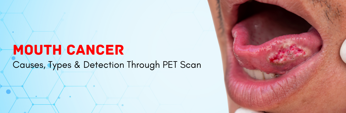 Mouth Cancer: Causes and Diagnosis